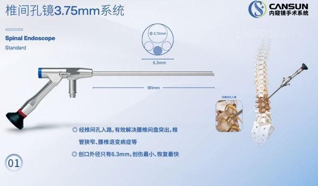 脊柱内窥镜（椎间孔镜）