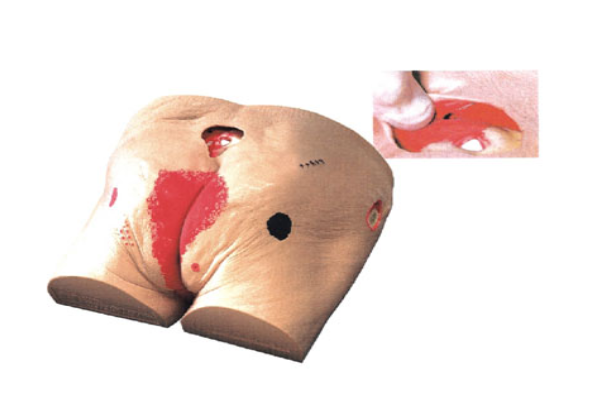压疮护理模型